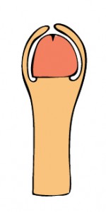 penis met fimosis fimosis